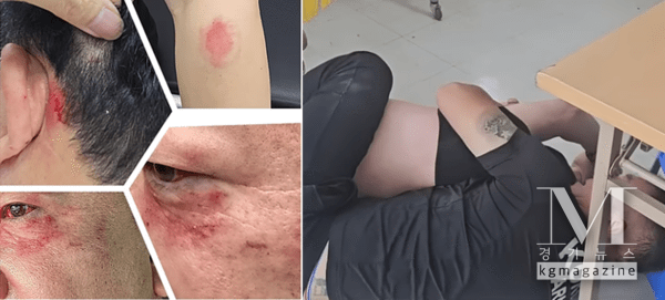 의원 측근으로부터 폭행을 당했다고 호소하고 있는 지역 일간지 소속 기자(사진= 얼굴눈과 안면부, 머리 등에 심한 상처를입은 피해 기자모습과 폭행당시 모습