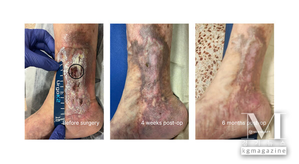 Restorative effect of replacing diseased vein with fully biological P-TEV personalized tissue engineered vein